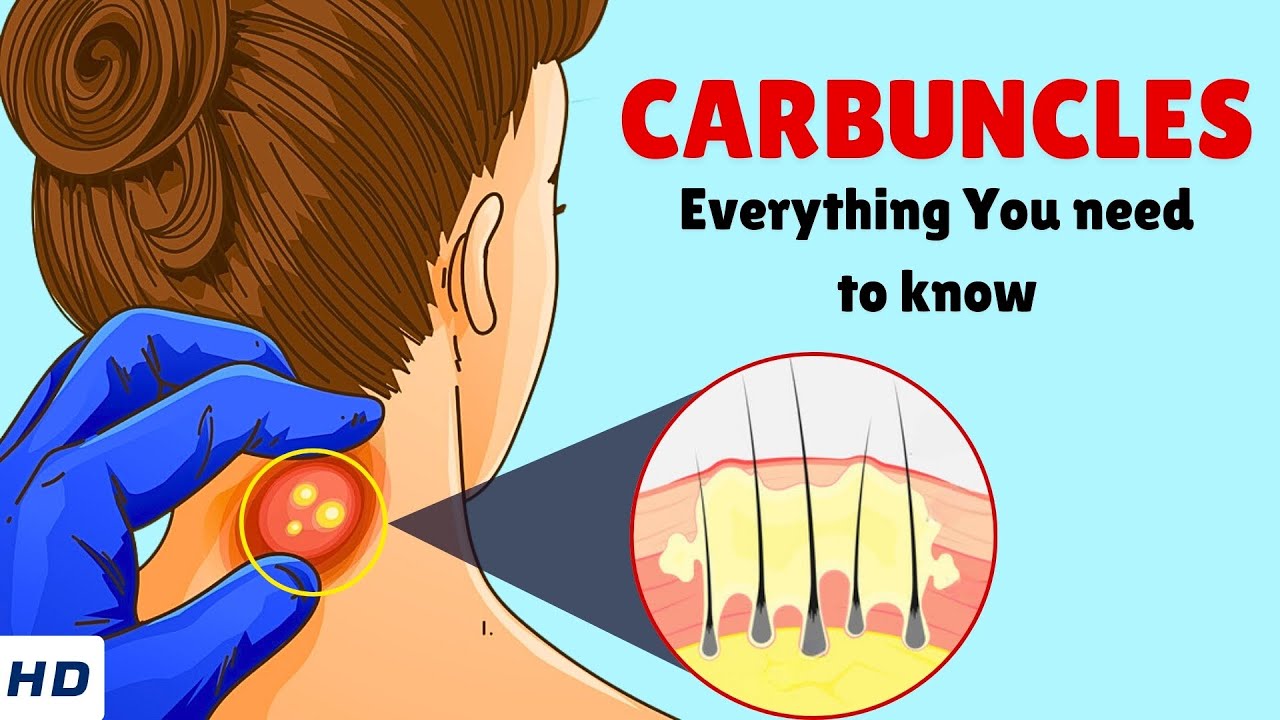 Carbuncles &ndash; Causes, Signs and Symptoms, Diagnosis & Treatment
