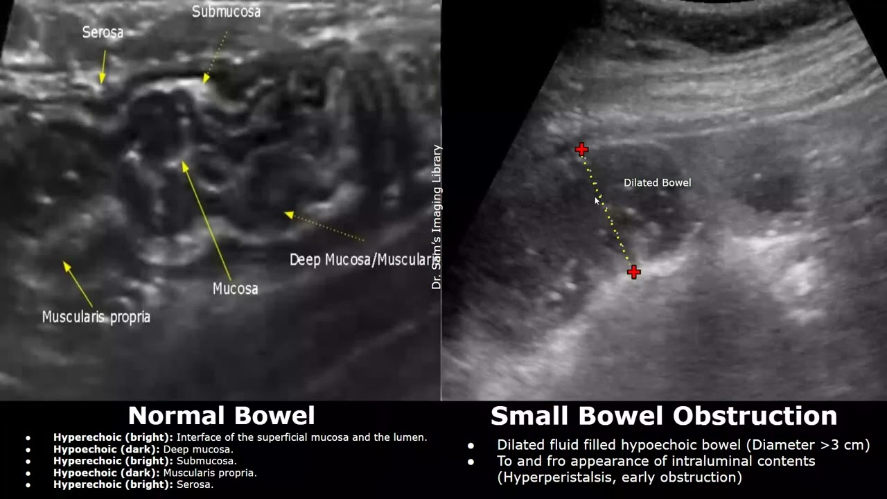 Abdominal Ultrasound Normal Bowel Vs Small Bowel Obstruction Image Appearances | Dilated Bowel USG