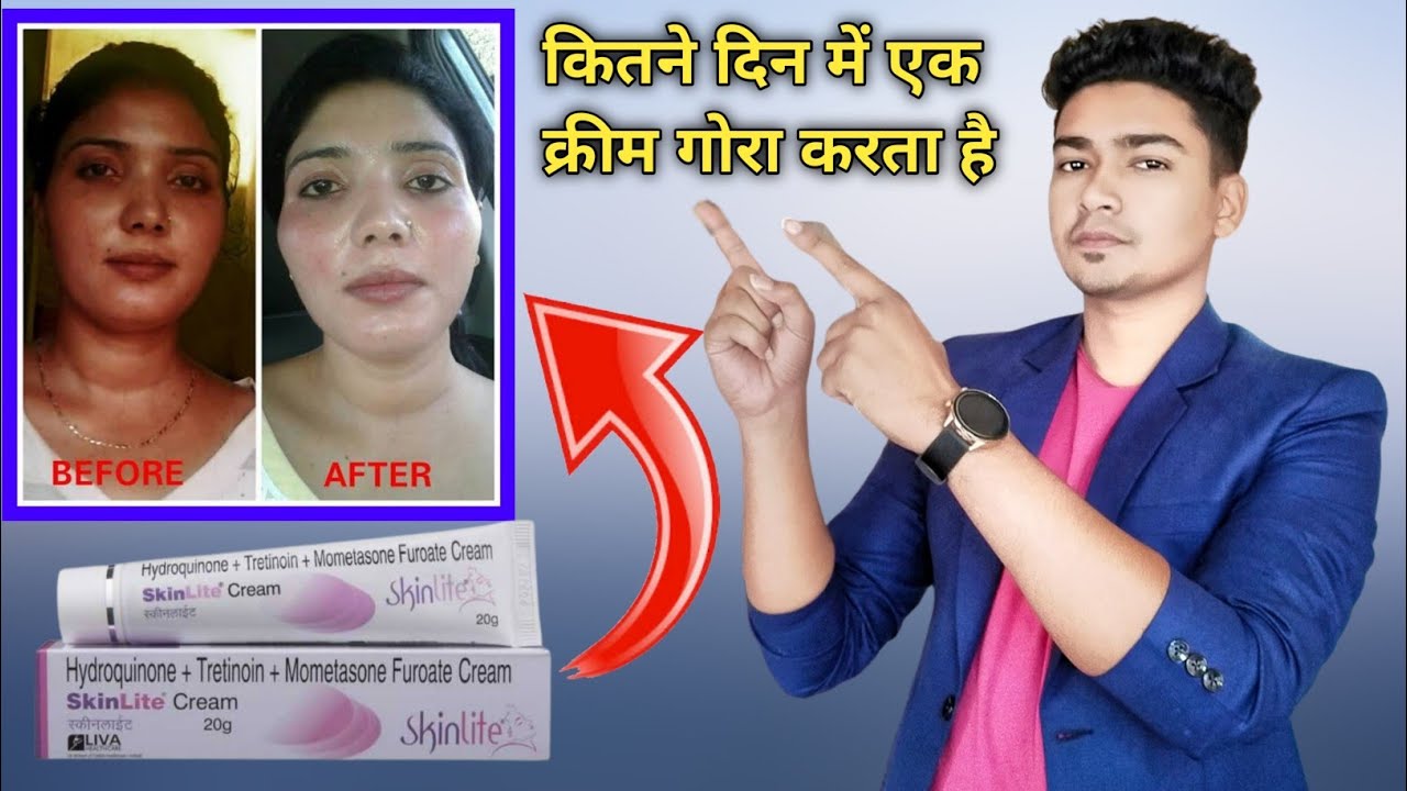 Skinlite cream review | एक क्रीम से चेहरा गोरा करने पर क्या साइड इफेक्ट होता है