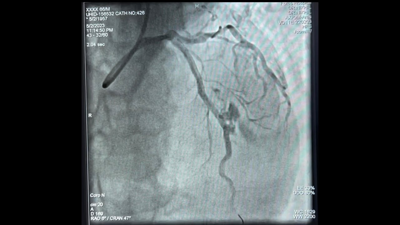 Coronary artery perforation Covered stent by ping pong technique PCI complication nightmare