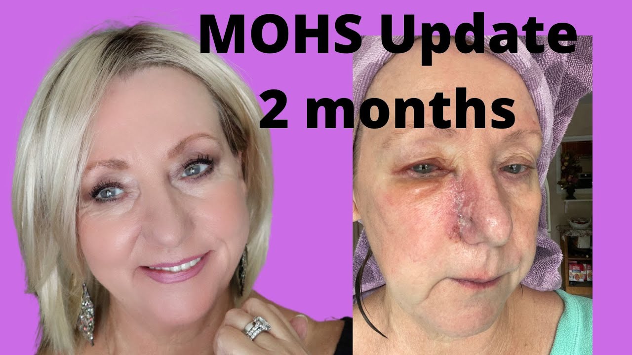 MOHS Surgery | 2 Month Update | Scar Care| Monika's Beauty & Lifestyle