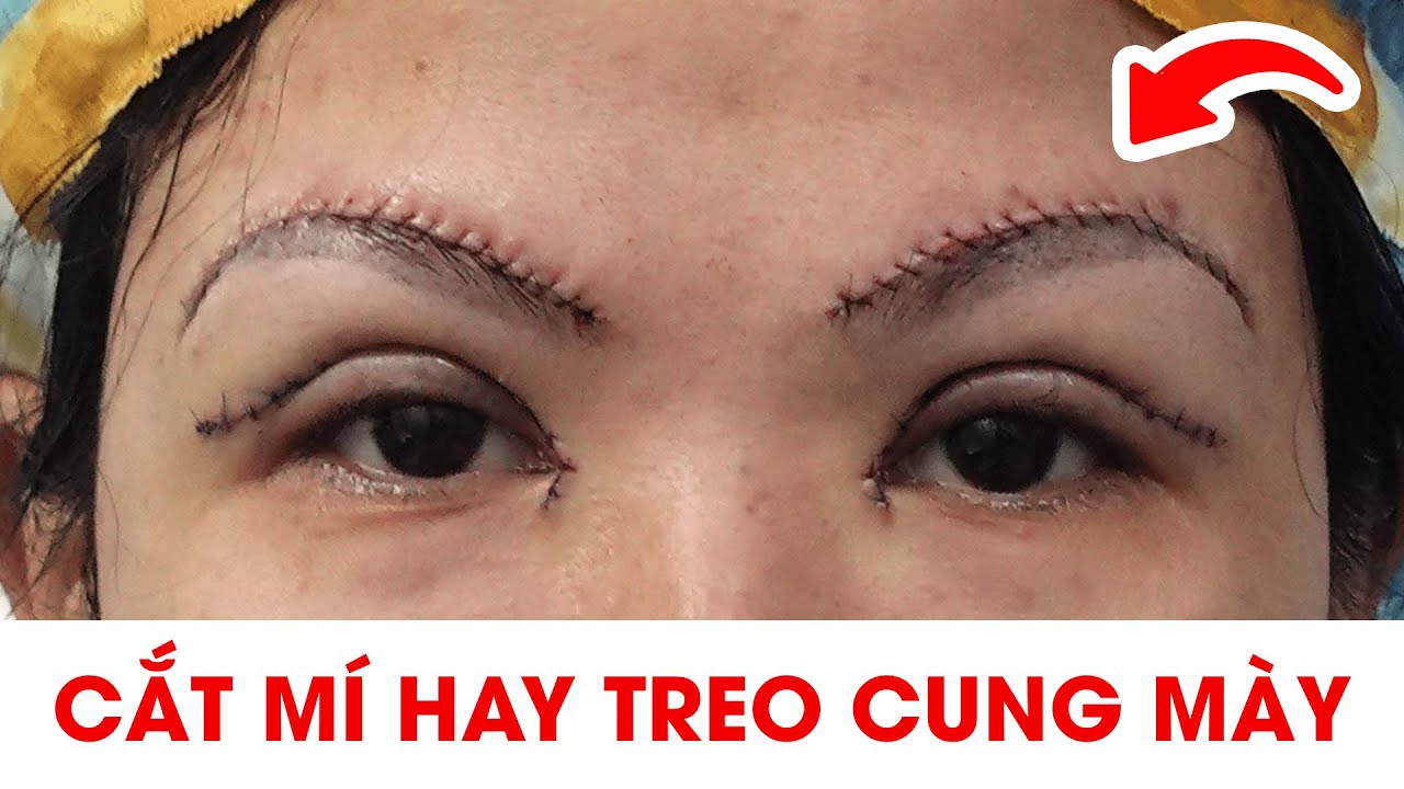 Đừng vội đi Cắt Mắt hay Treo Cung Mày ! Hãy xem video này trước khi quyết định !