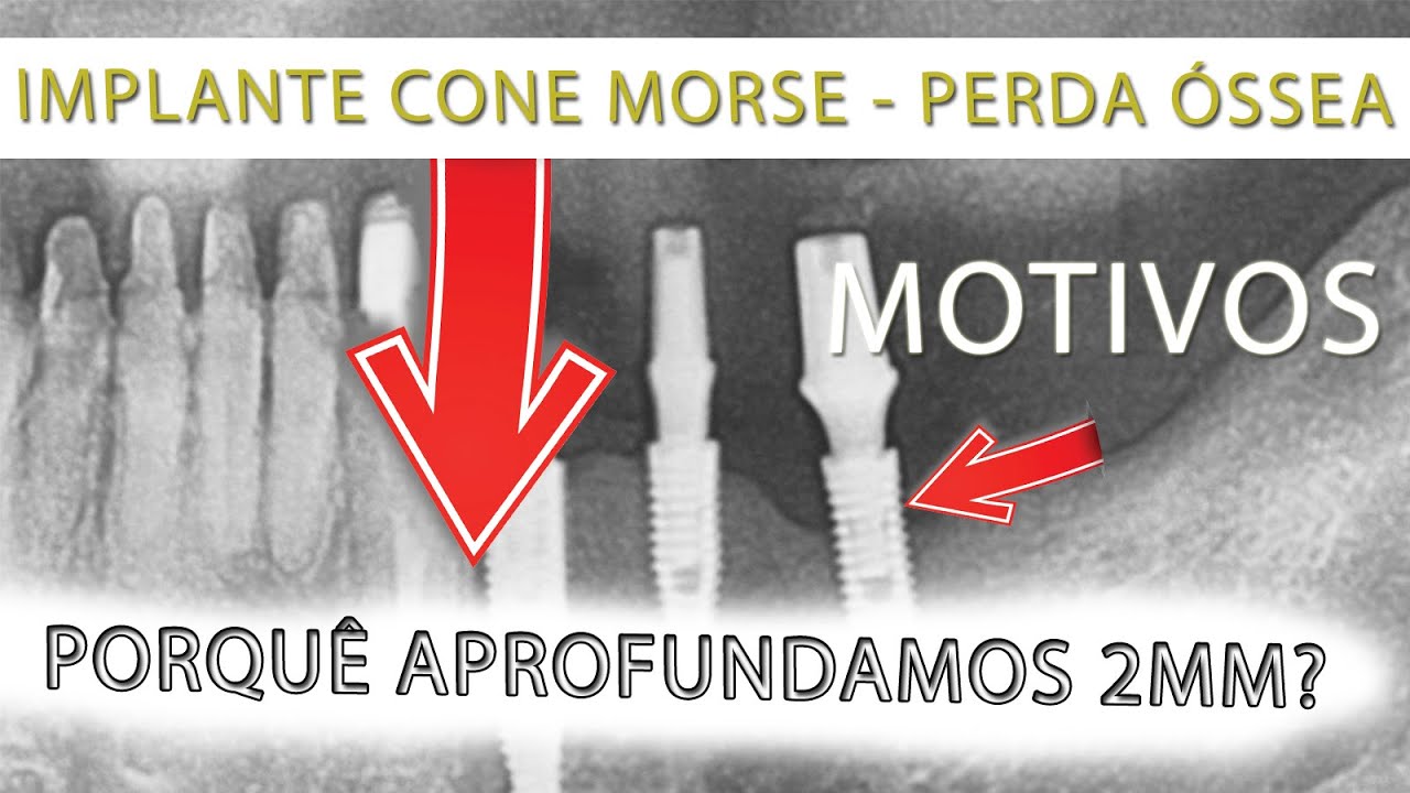 (Ep 63) IMPLANTE CONE MORSE PERDA ÓSSEA (CC ANY LANGUAGE)