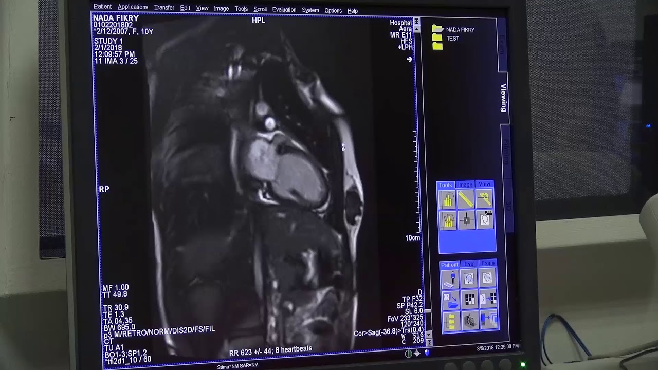 Cardiac MRI acquisition part 2