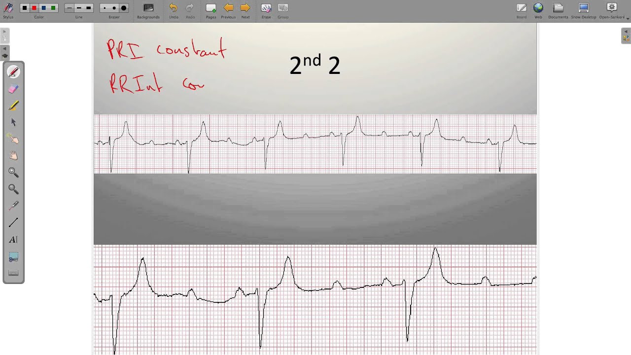 ECG Heart Blocks