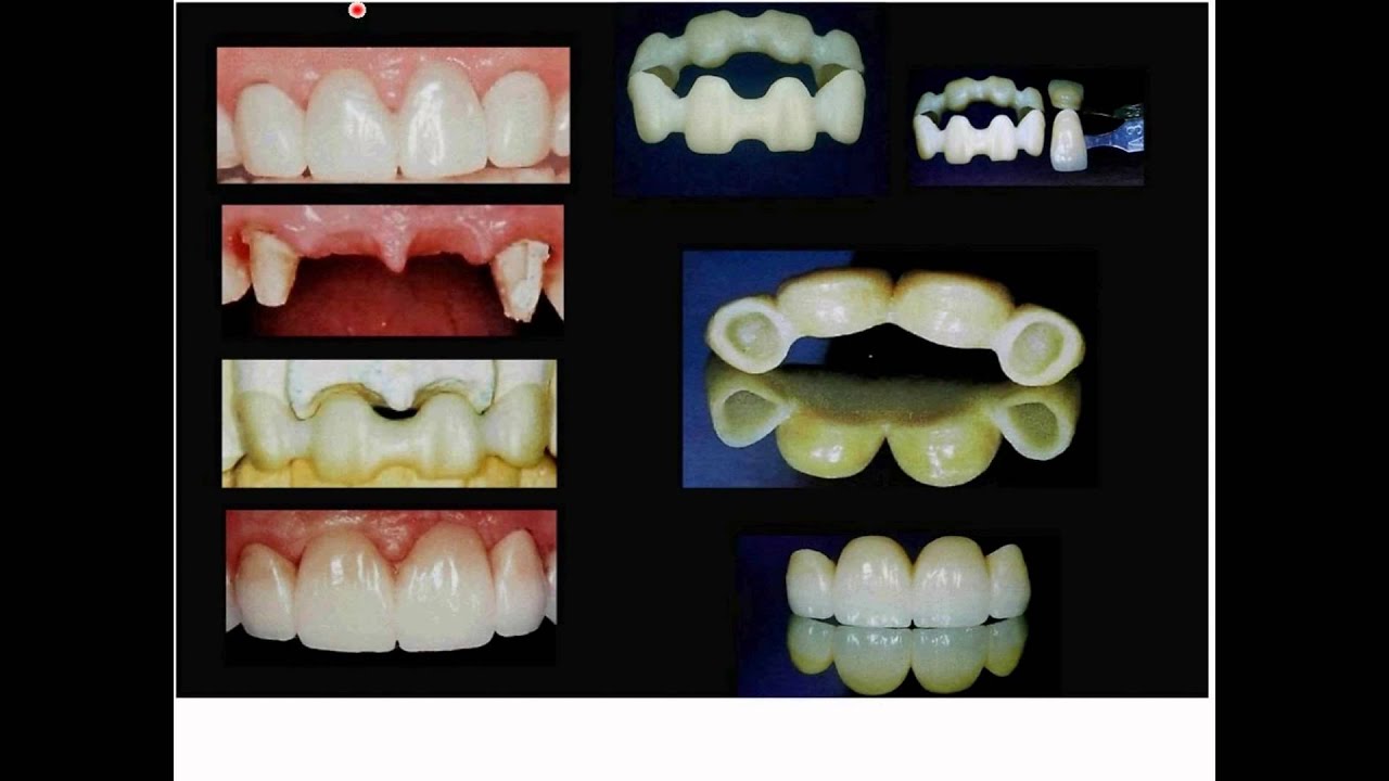 039 Coronas de LAVA Zirconia - Una alternativa estética