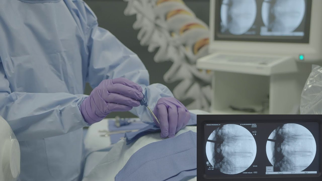 Arcadia™ Balloon Catheter: Unipedicular Vertebral Augmentation In-Service