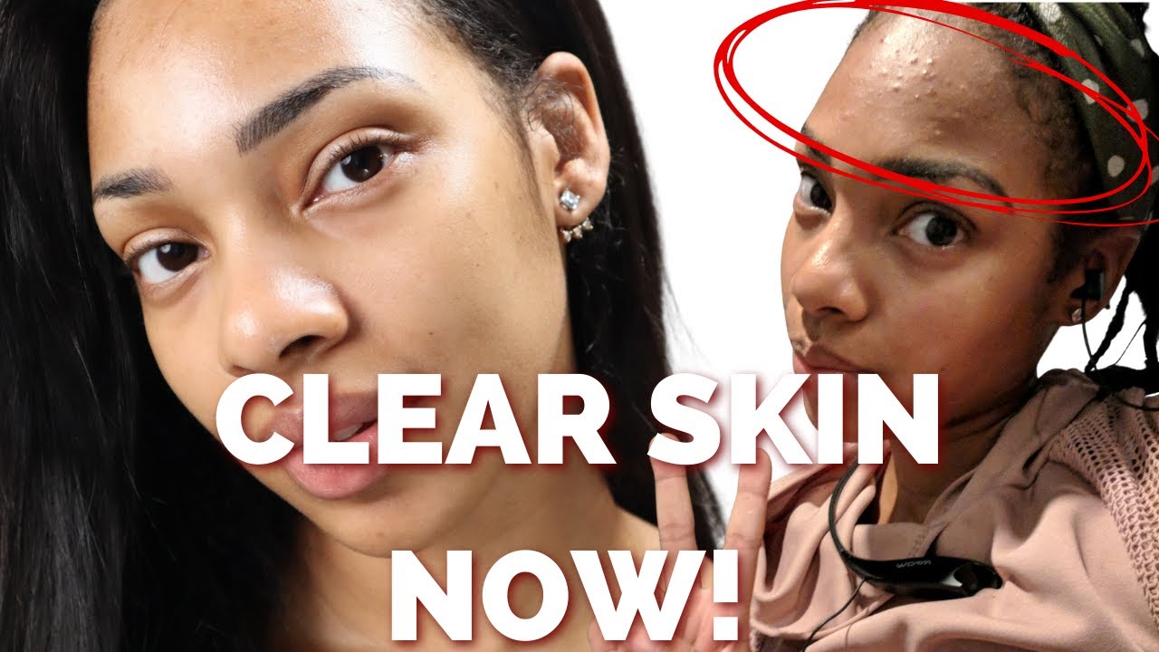 A WEEK IN MY SKIN CARE ROUTINE | DRY SKIN, FUNGAL ACNE (malassezia folliculitis) , HYPERPIGMENTATION
