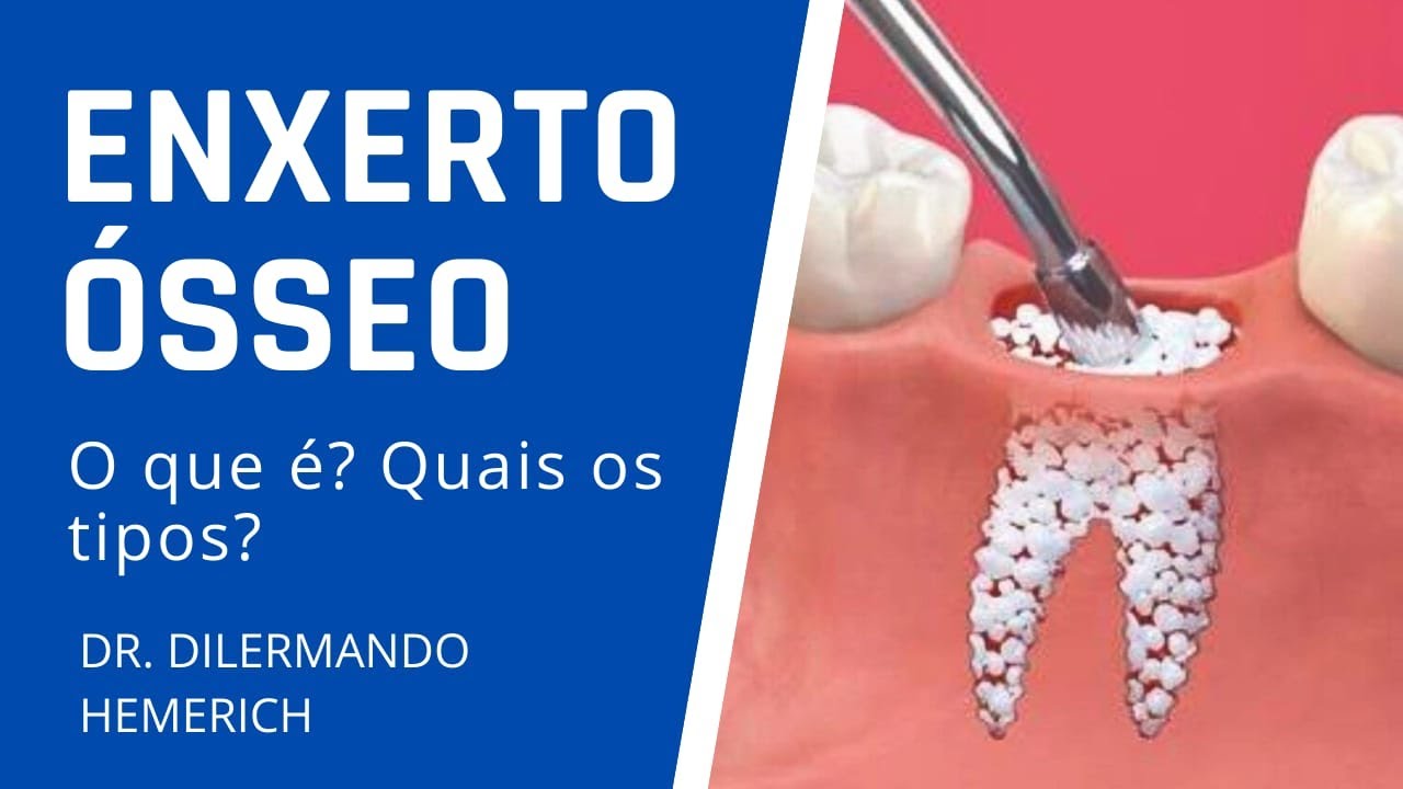 ENXERTO ÓSSEO | O que é? Qual o melhor?