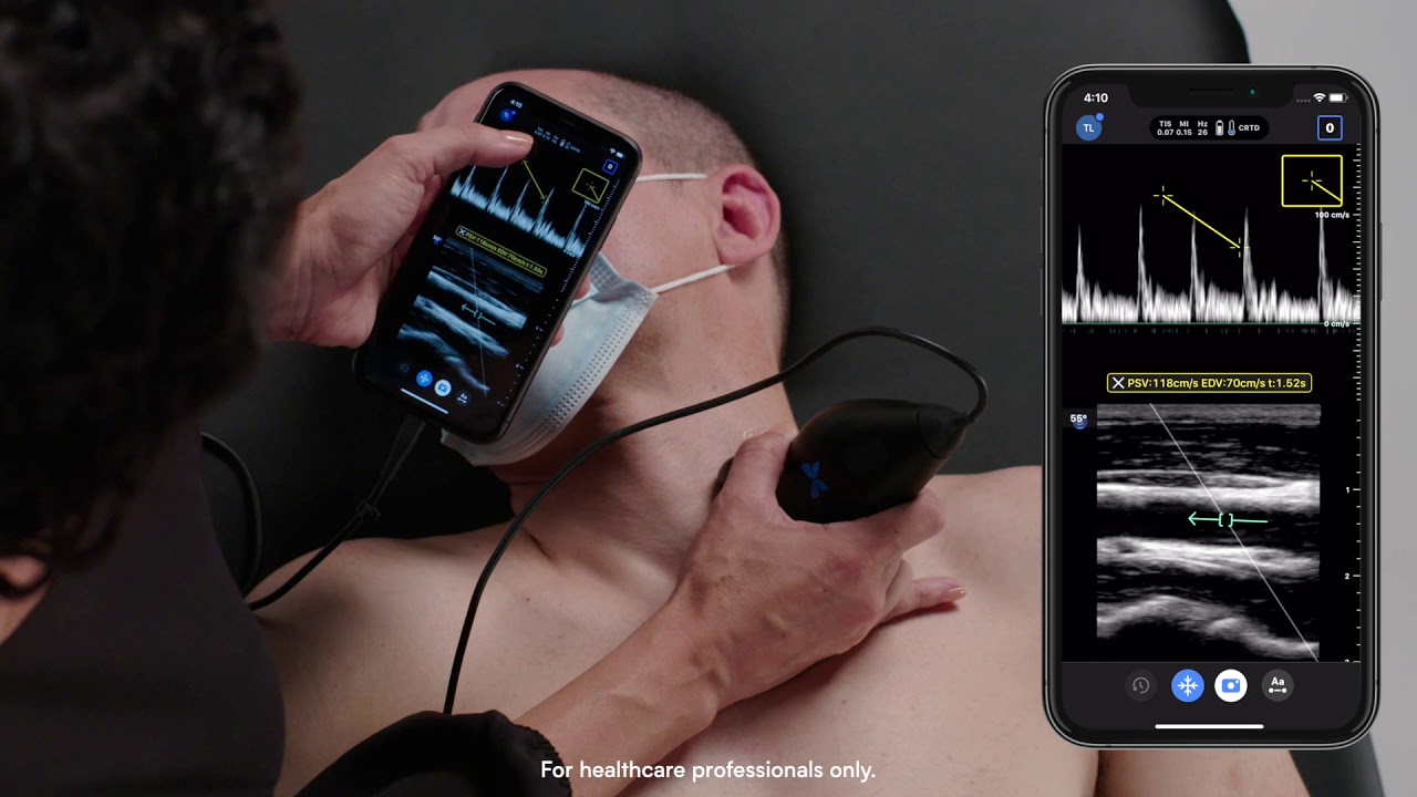 Ultrasound Education: Pulsed Wave Doppler mode on the Vascular: Carotid Preset