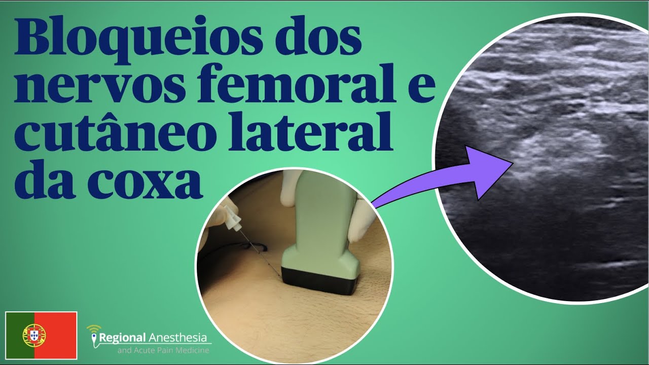 Bloqueios dos nervos femoral e cutâneo lateralda coxa