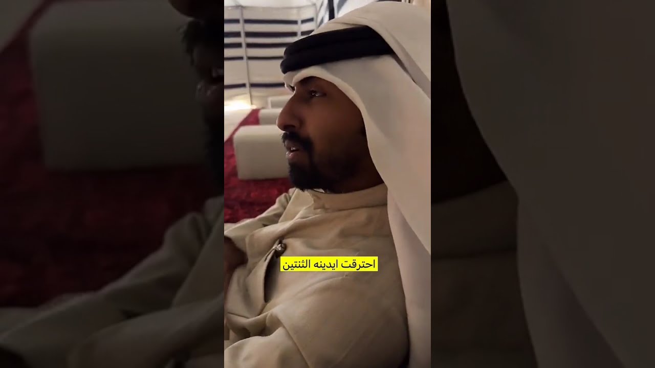 احترقت ايدينه الثنتين 💔