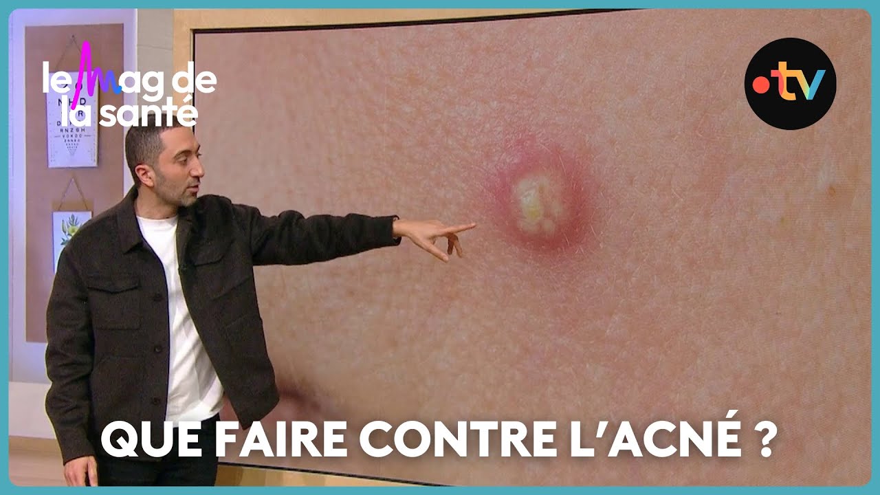 Nos conseils pour traiter correctement l'acné
