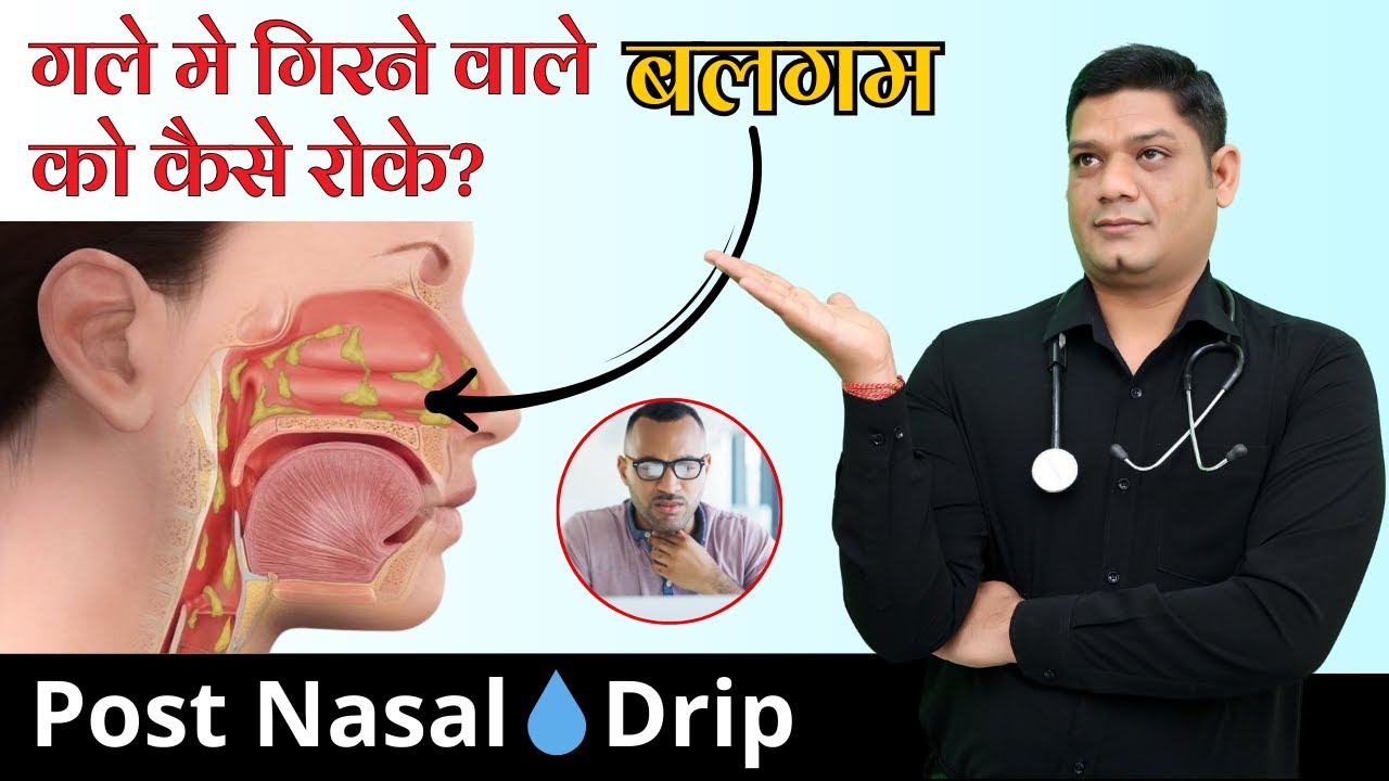 Post-Nasal Drip Homeopathic Treatment | गले में बलगम का गिरना | Causes, Symptoms & Medicines