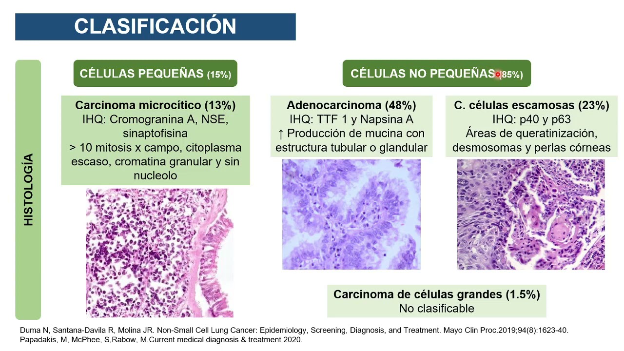 CÁNCER PULMONAR -SCSF