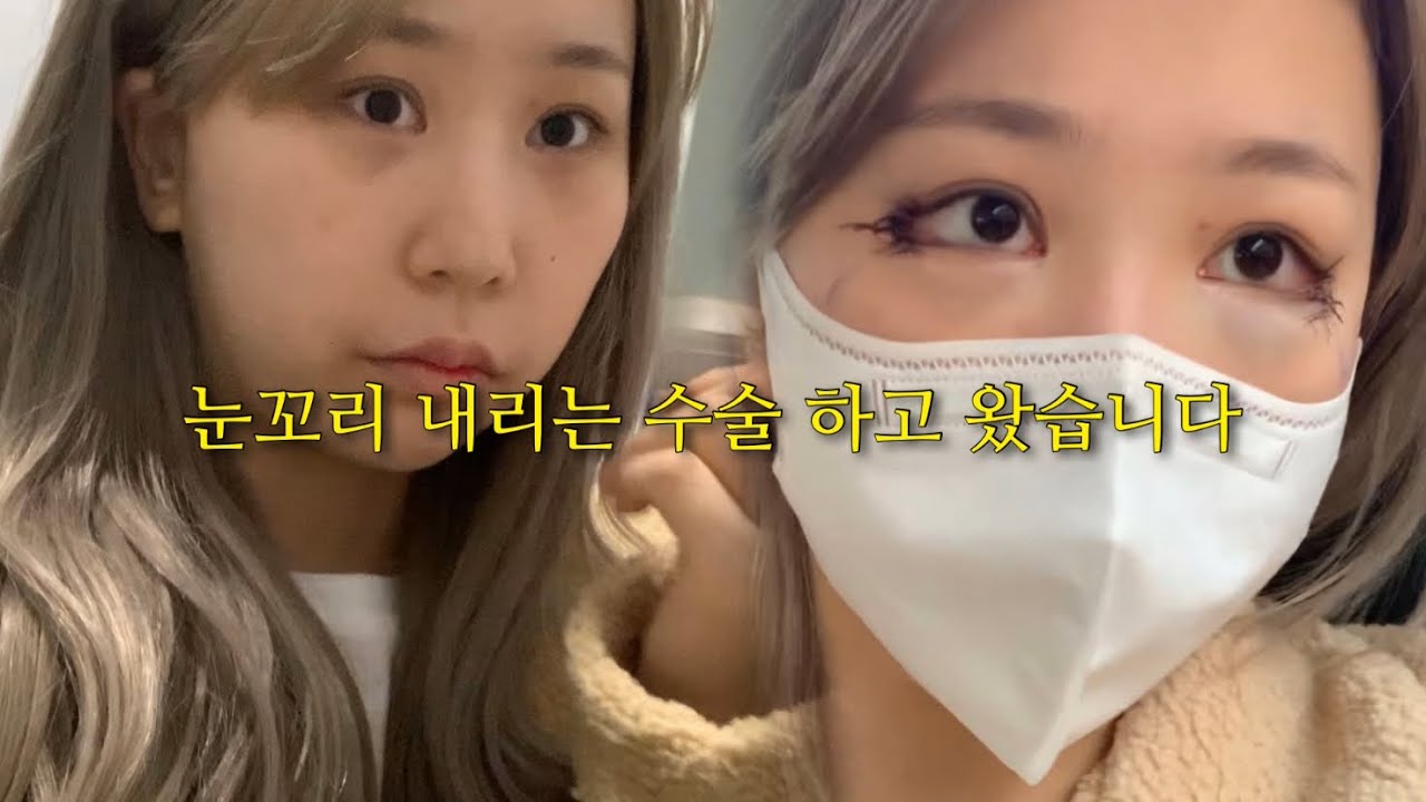 눈꼬리 내리는 성형 하고왔어요