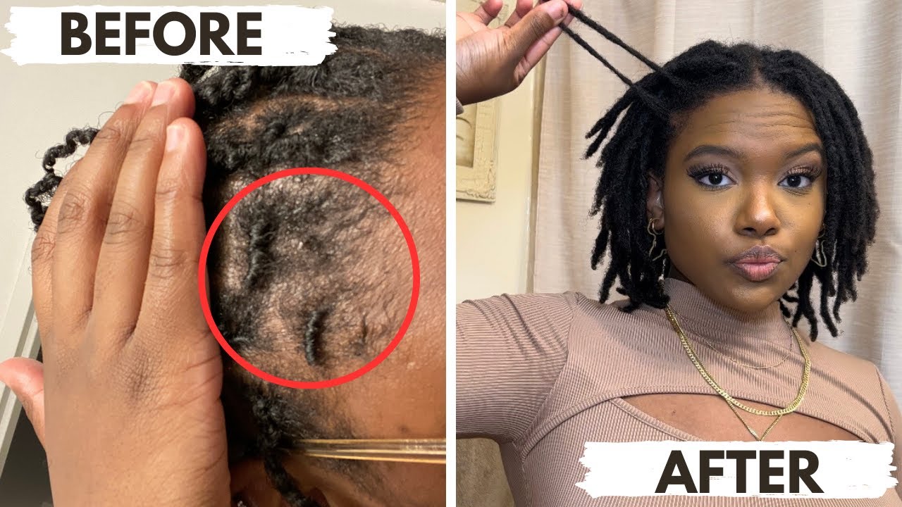 HOW I GREW MY EDGES | HOW TO GROW THINNING EDGES/ HAIRLINE BACK FAST! (LOC FRIENDLY!)