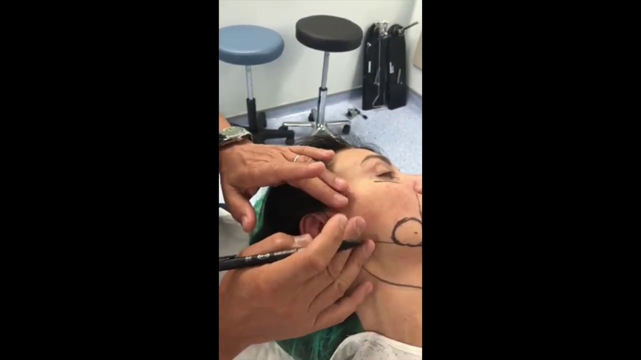 Lifting facial y liposucción de  papada - Parte 1