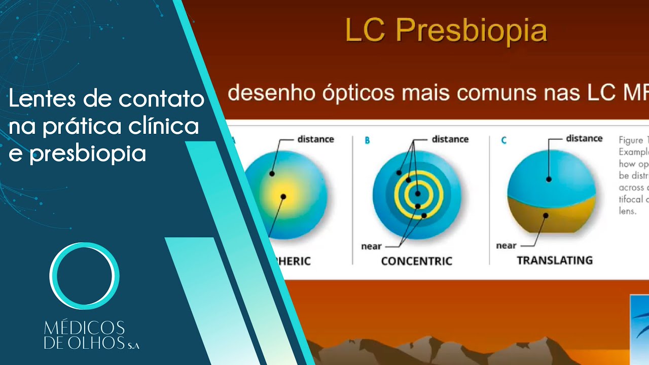 Videoaula Lentes de contato na prática clínica e Presbiopia