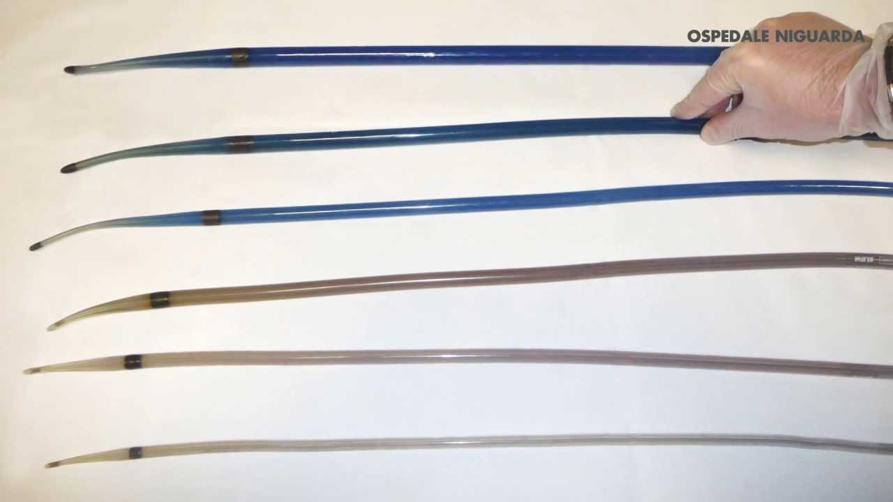 Dilatazione endoscopica di un restringimento del tratto gastrointestinale