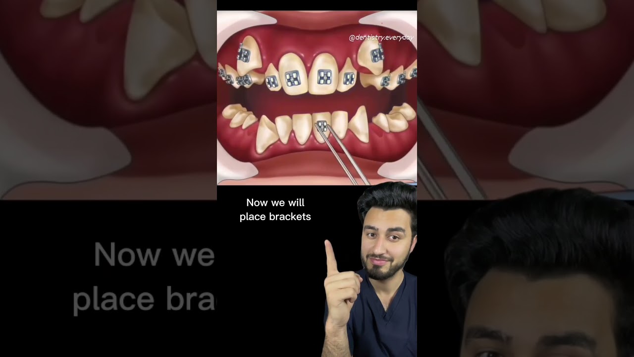 This is how we correct over crowding of teeth | #viral #shortvideo #shorts #short #subscribe #like