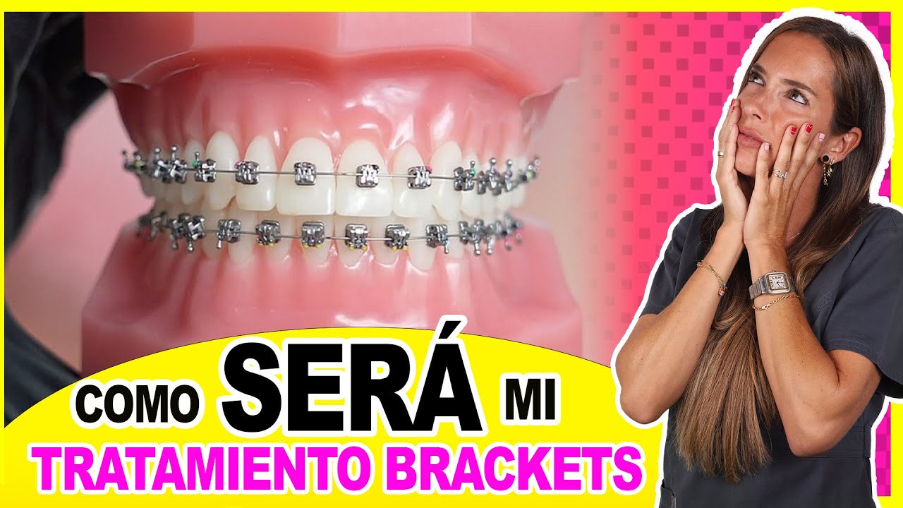 𝗣𝗥𝗢𝗖𝗘𝗦𝗢 𝗽𝗮𝗿𝗮 𝘂𝘀𝗮𝗿 𝗕𝗥𝗔𝗖𝗞𝗘𝗧𝗦: Si los tienes recién puestos o te los pondrán ¡Deberías 𝗩𝗘𝗥 este video!