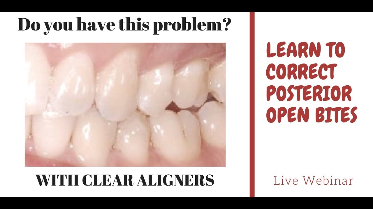 Posterior open bite webinar - Orthodontic Matters Episode 12