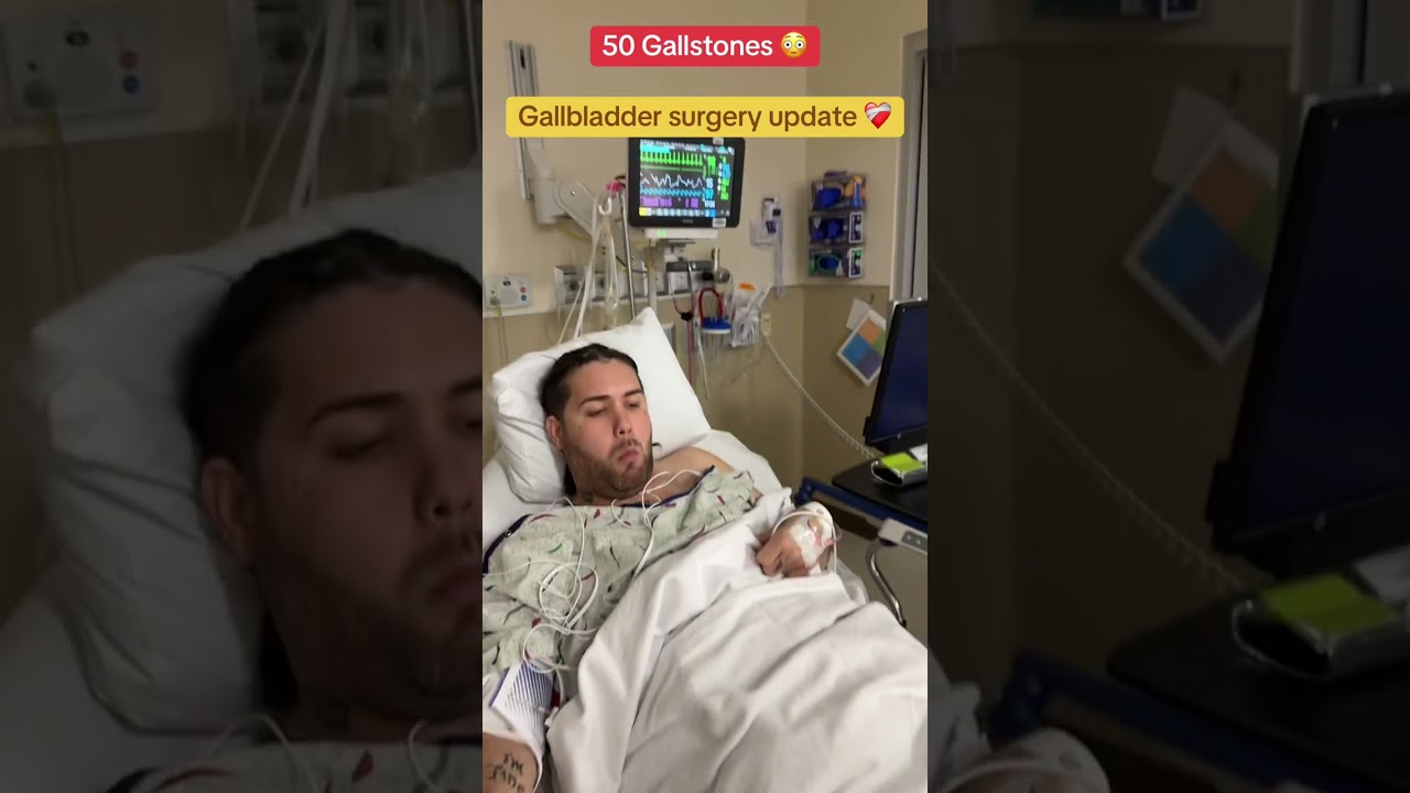 Update on my gallbladder surgery had 50 stones  #gallbladdersurgery #fyp #shorts #viral #shortsfeed 