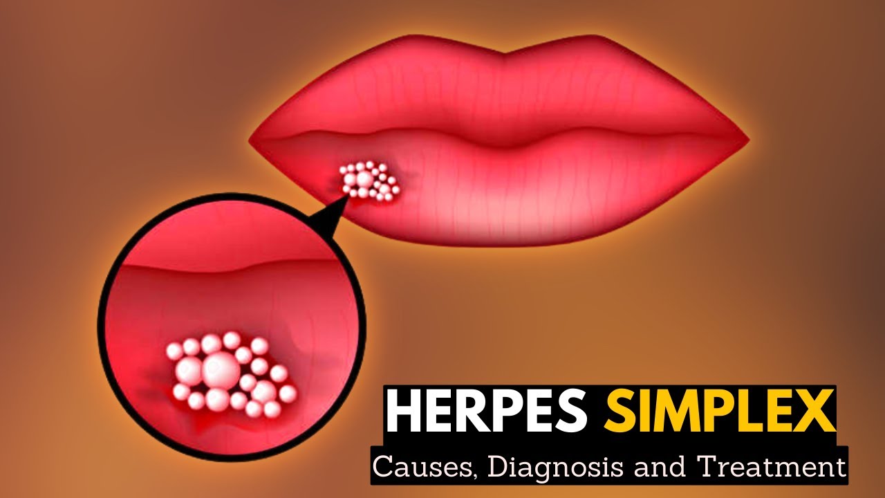 Herpes Simplex, Causes, Signs and Symptoms, Diagnosis and Treatment.