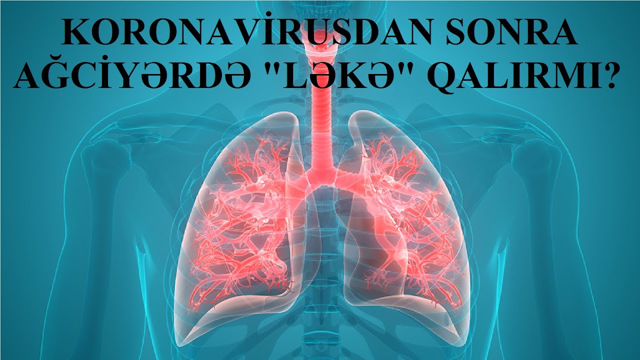 Koronavirusdan sağalanların ağciyərlərində 