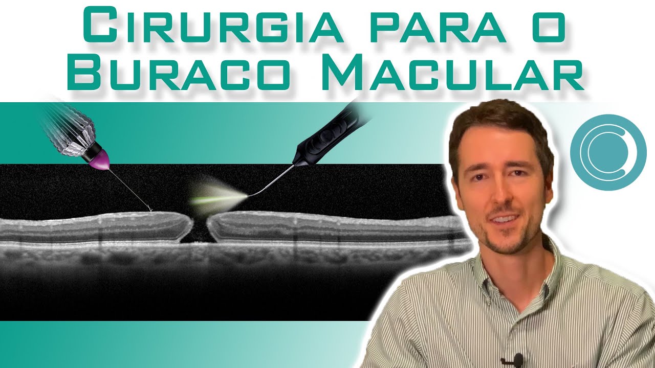 Cirurgia de vitrectomia para o buraco macular.