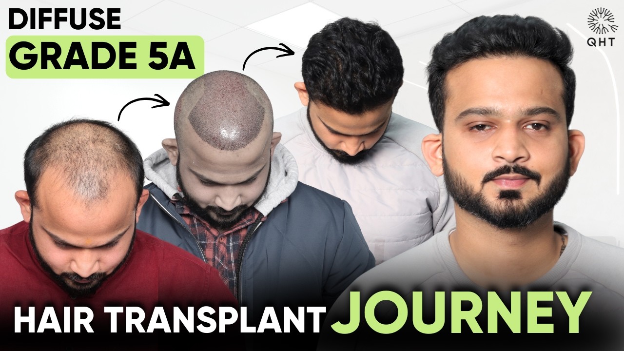 Grade 5 Hairloss | Diffuse Grade 5A Hair Transplant | Grade 5 Hair Transplant | Grade 5 | QHT | 2026