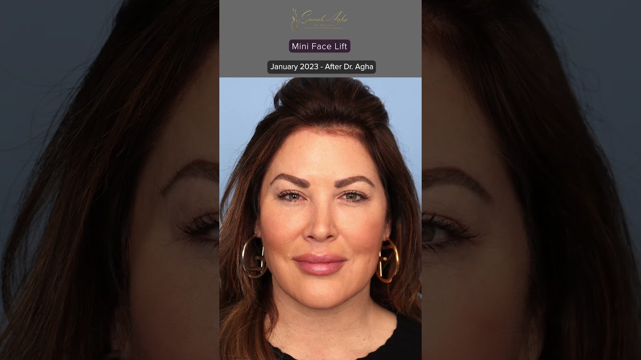 Emily Simpson Real Housewife of Orange County Facelift Journey