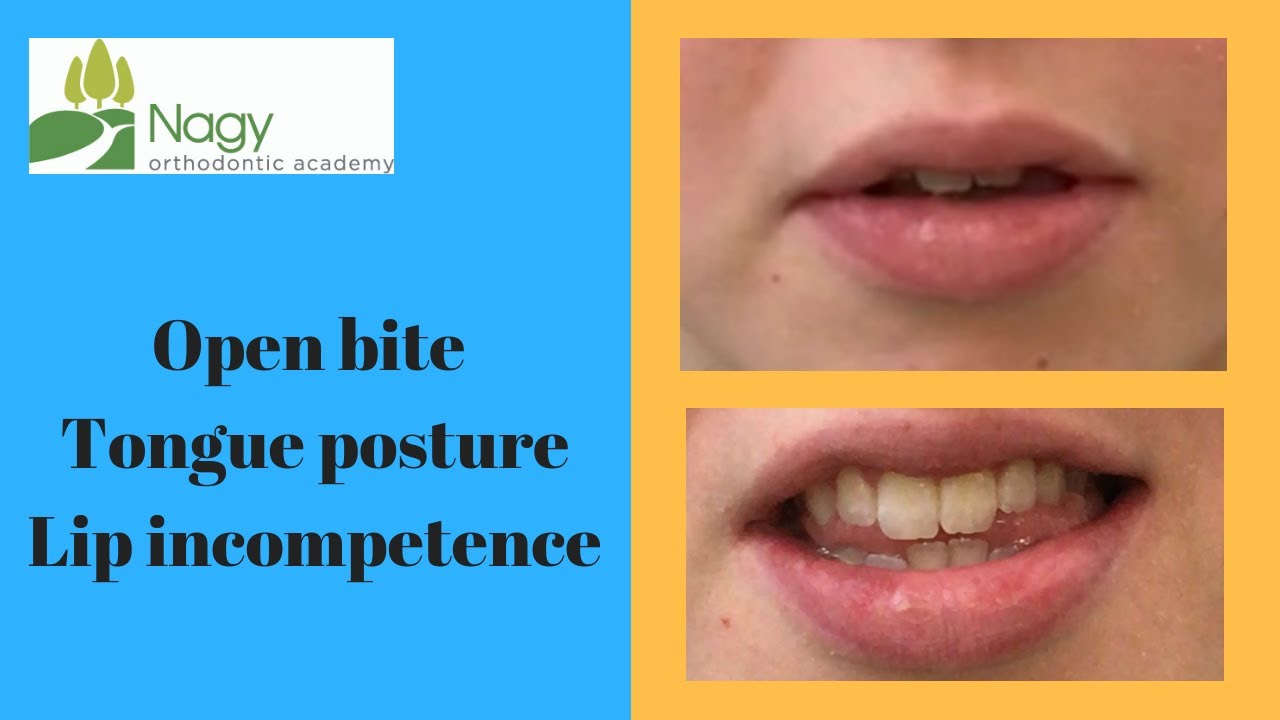 Open bite, tongue posture, and lip incompetence.