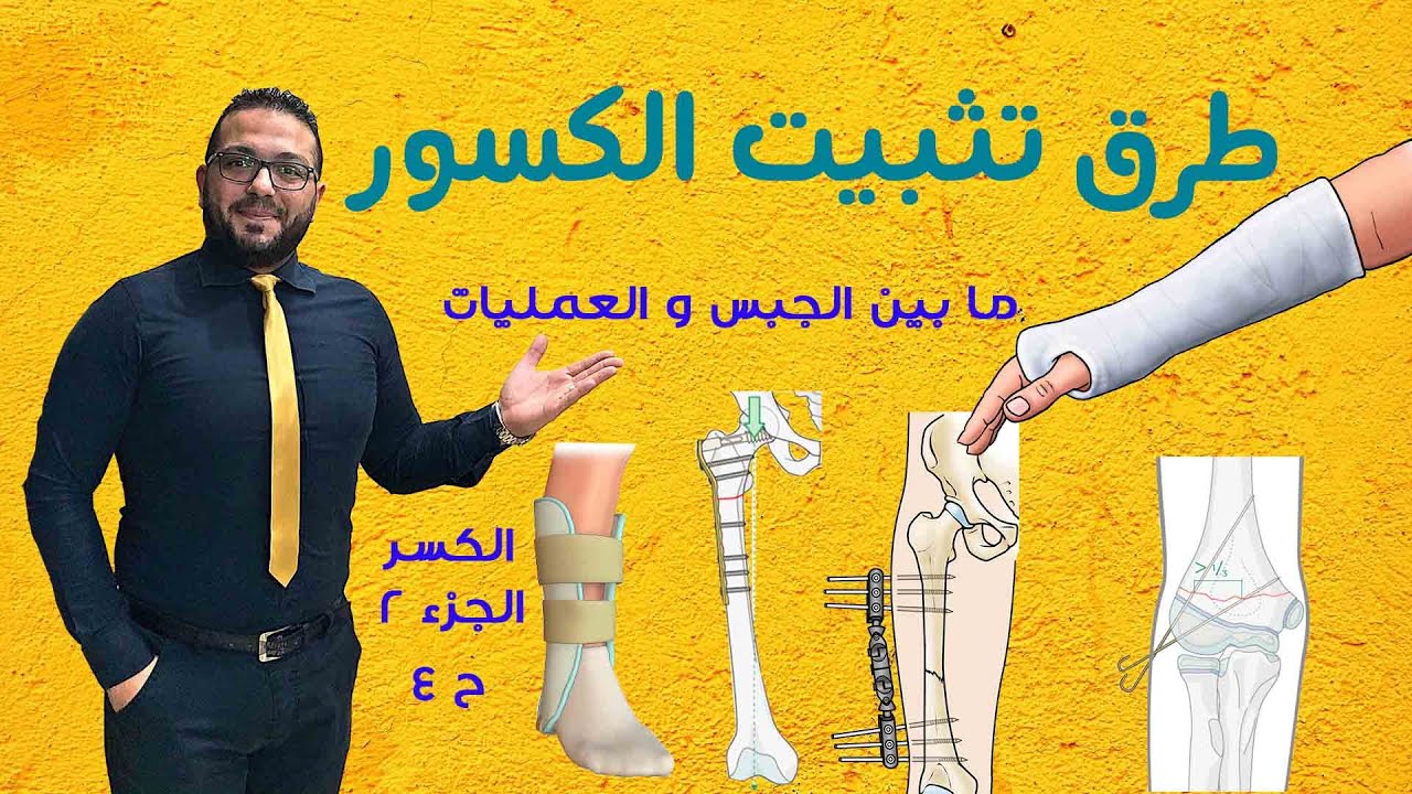 علاج كسرالعظام | طرق تثبيت الكسور بأنواعها | جبس ولا عملية ؟! | الجزء الثاني | الحلقة 4