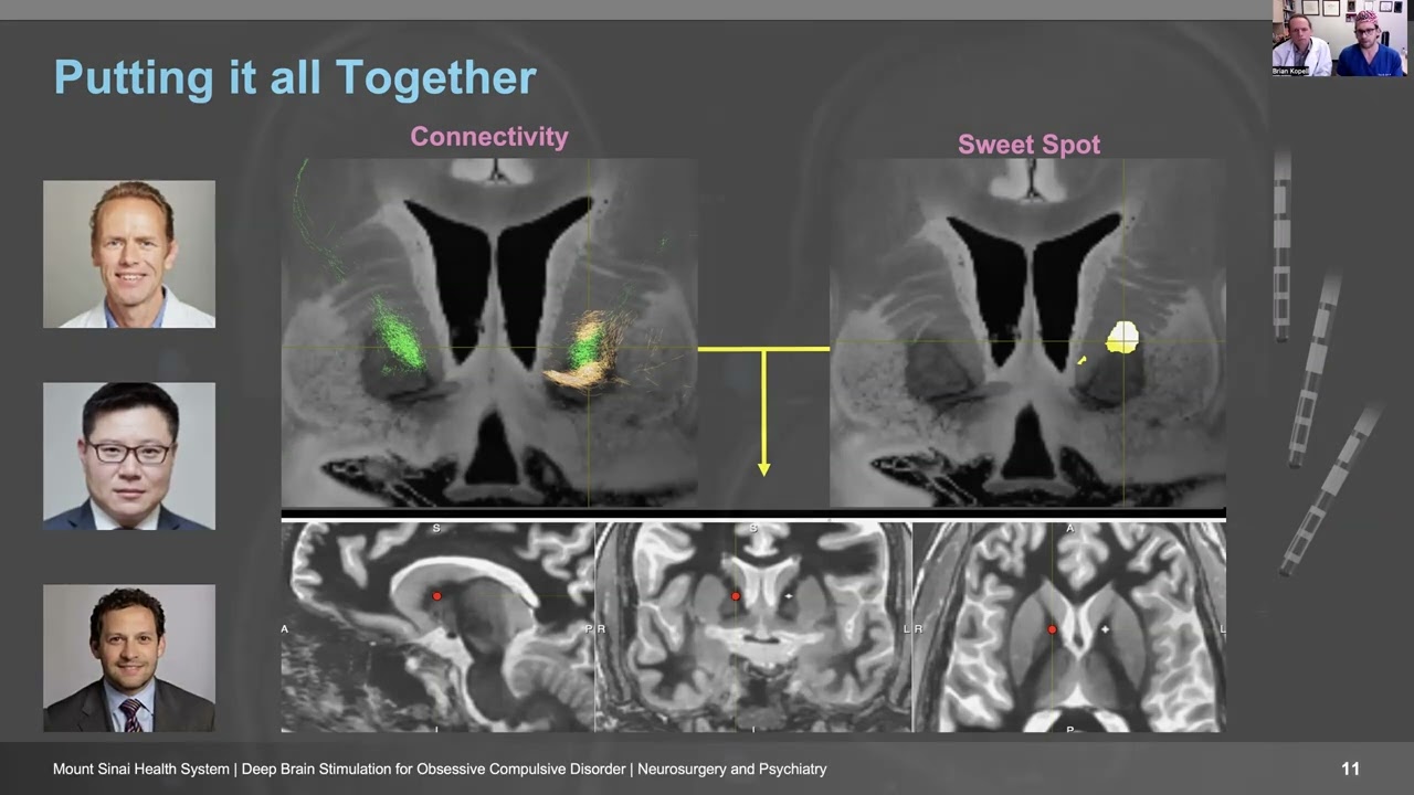 Deep Brain Stimulation (DBS) for Obsessive-Compulsive Disorder (OCD)
