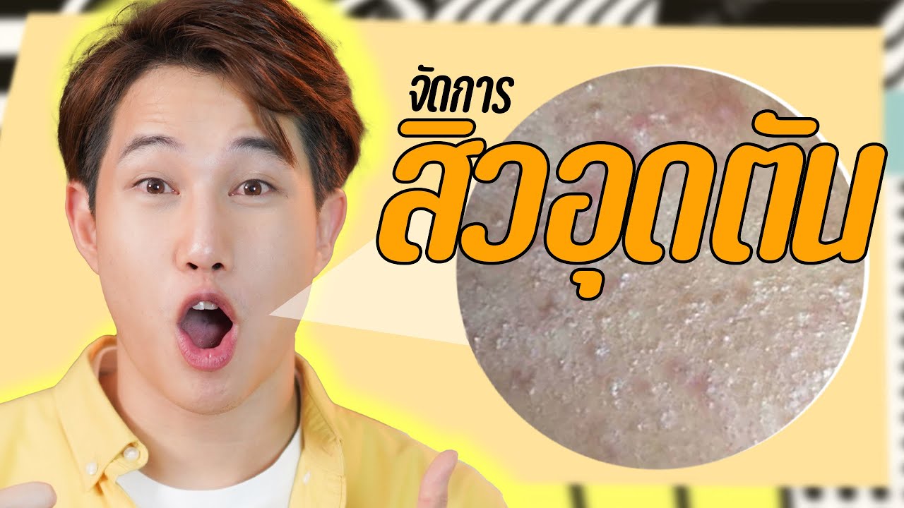 สิวอุดตัน รักษายังไง รักษาสิวด้วยตัวเอง แบบไม่ต้องกดสิว!! | เอามั้ยลองไมค์