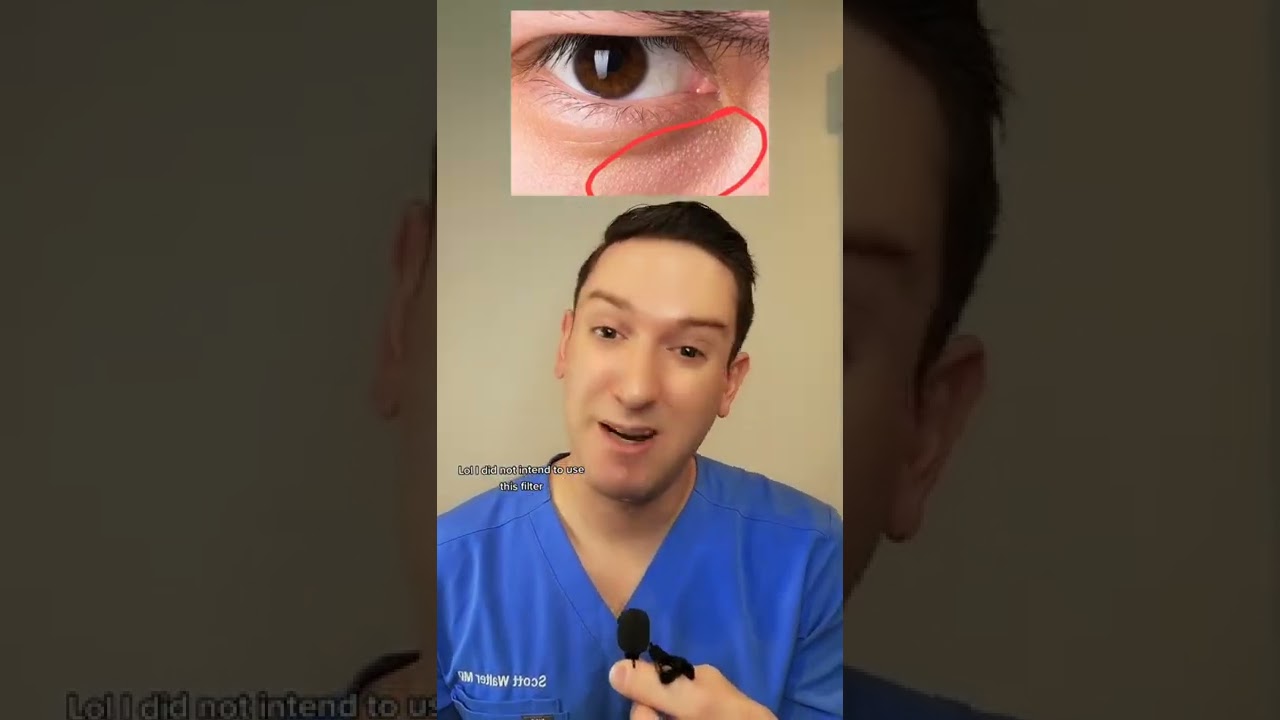 What are those little BUMPs under your eyes?! #undereyebumps #undereye #skinfacts