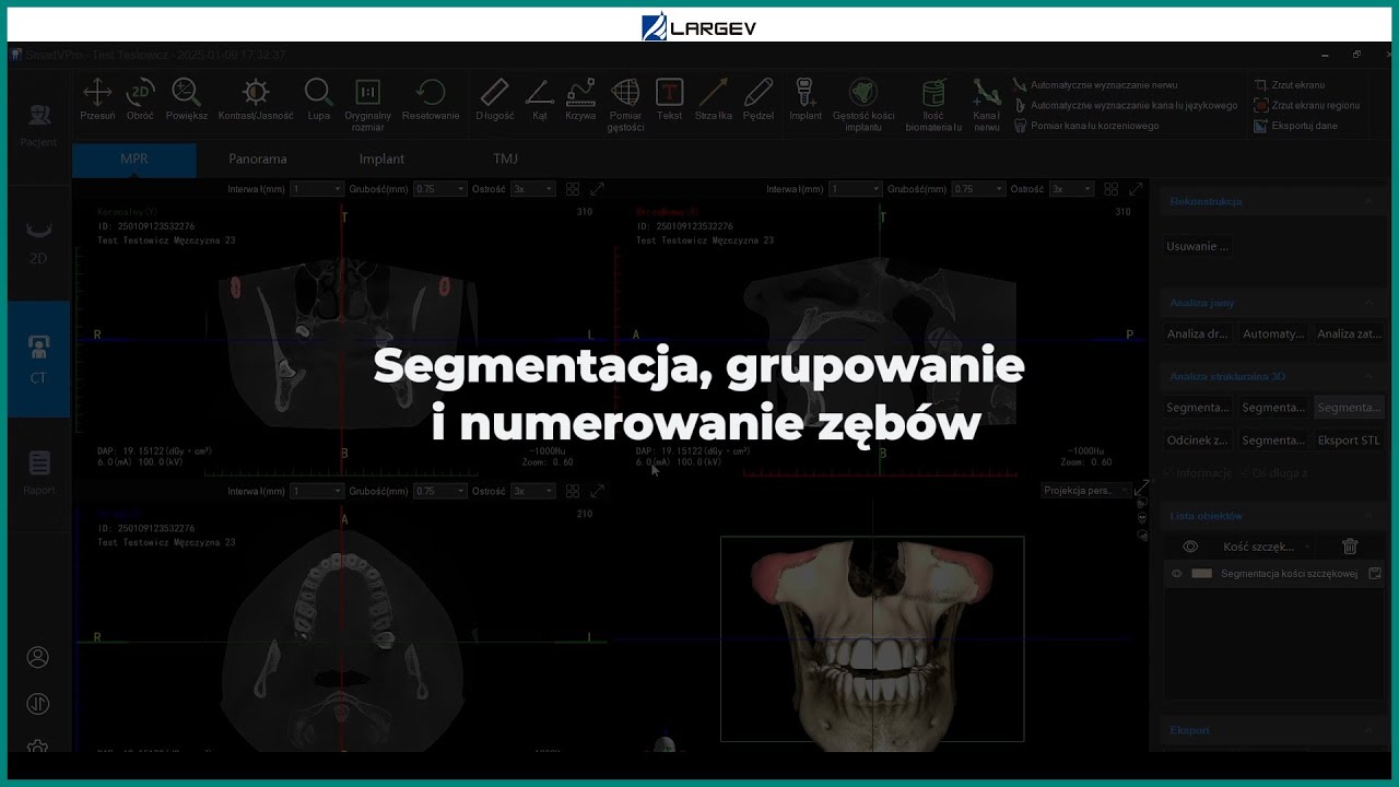 Tomograf stomatologiczny Smart3D-X - Segmentacja, grupowanie i numerowanie zębów