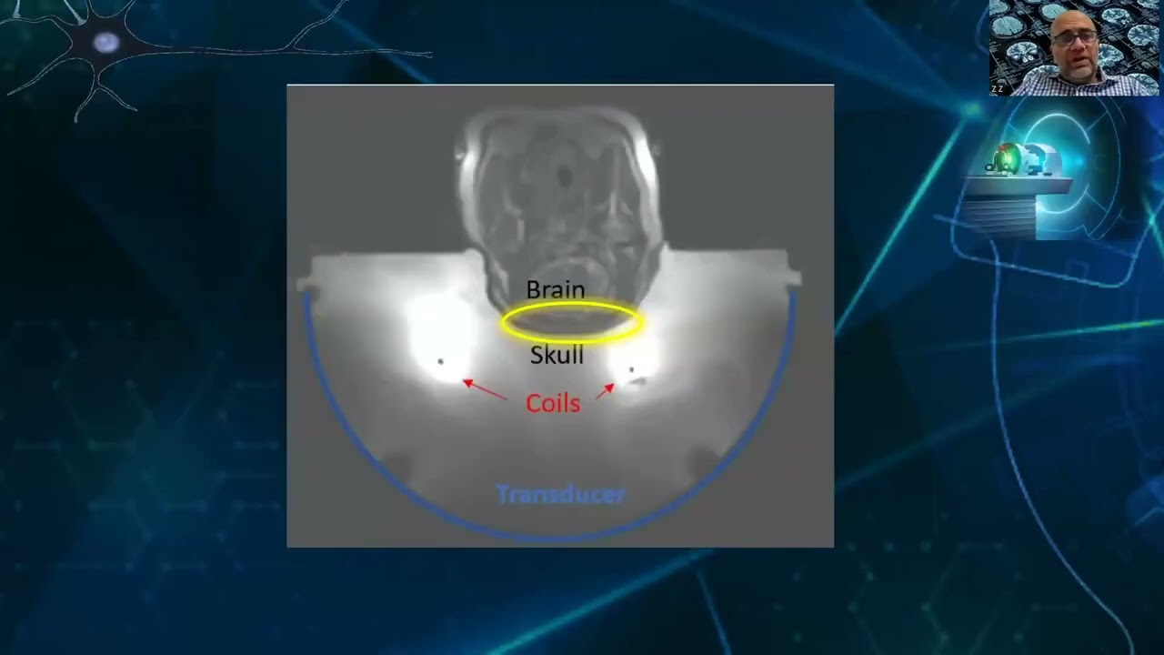 Zion Zibly: Feasibility of Brain Transcranial Mr-Guided High Intensity Ultrasound Histotripsy
