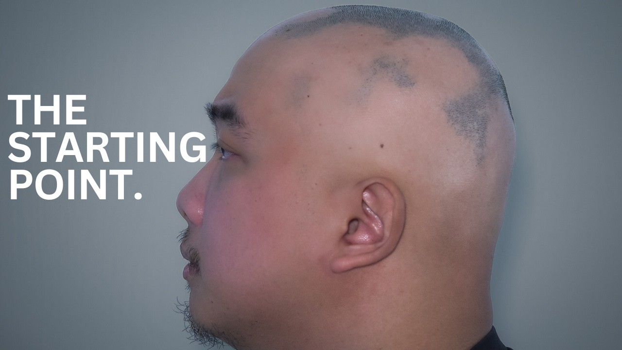Alopecia Areata – The Starting Point | Recovery Diaries EP. 01