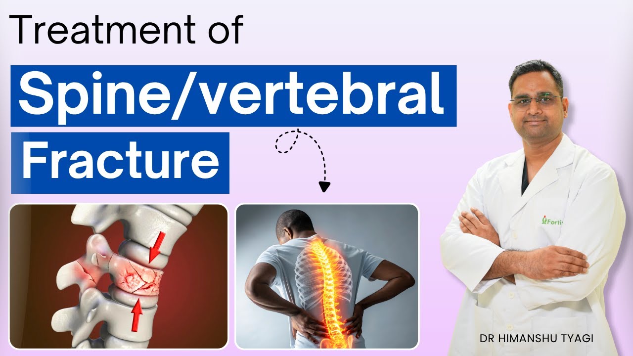 Treatment of Spine / vertebral fracture | Causes, Symptoms & Treatment ! Burst ! 
