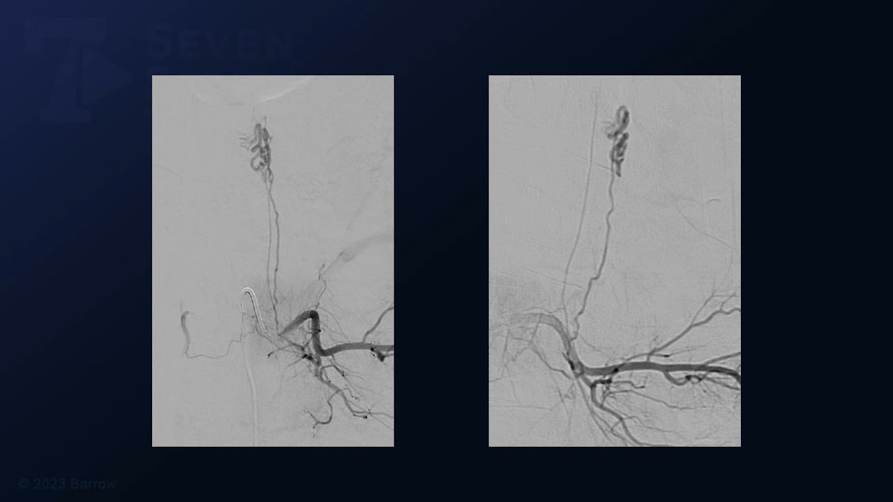 Microsurgical Resection of a Residual Conus Arteriovenous Malformation