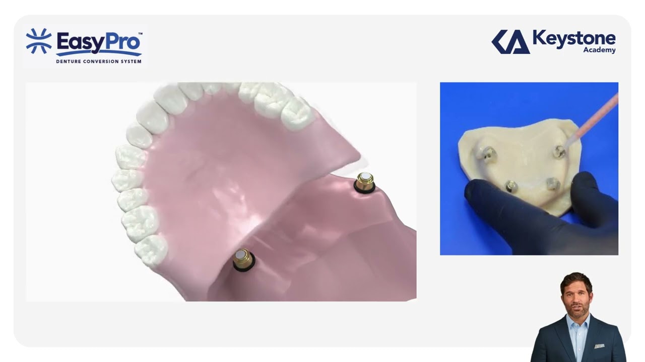 The EasyPro&trade; Denture Conversion System
