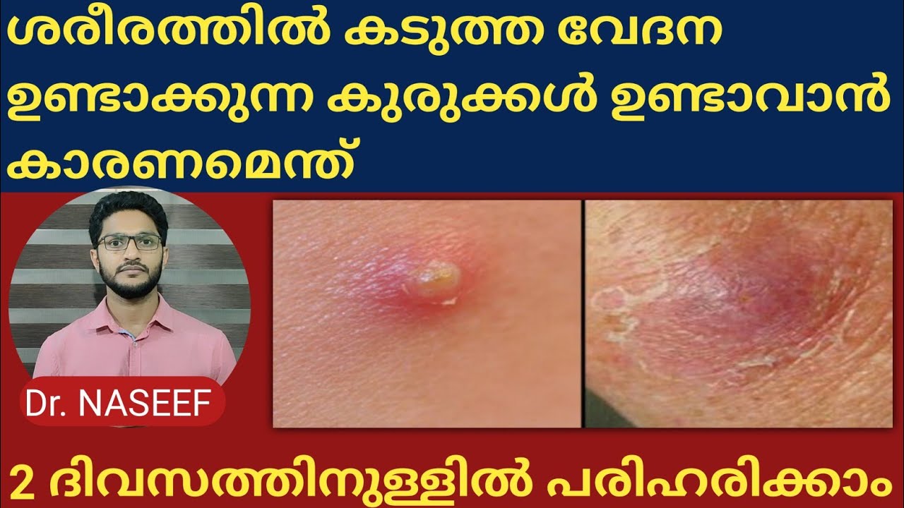 How to treat painful boils on the body