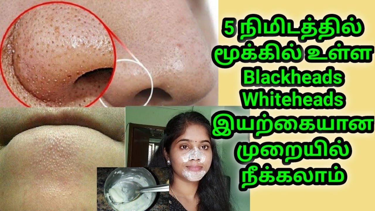 Remove Blackheads &Whiteheads In just 5minits at home | முகத்தில் உள்ள கரும்புள்ளி நீங்க எளிய வழி