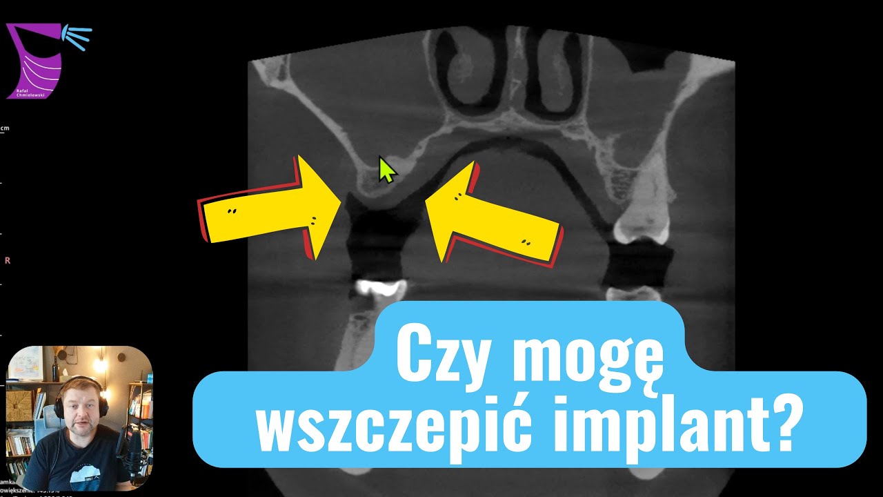 Czy Mogę Wszczepić Implant Zębowy? Tomografia Stomatologiczna  vs TK Zatok