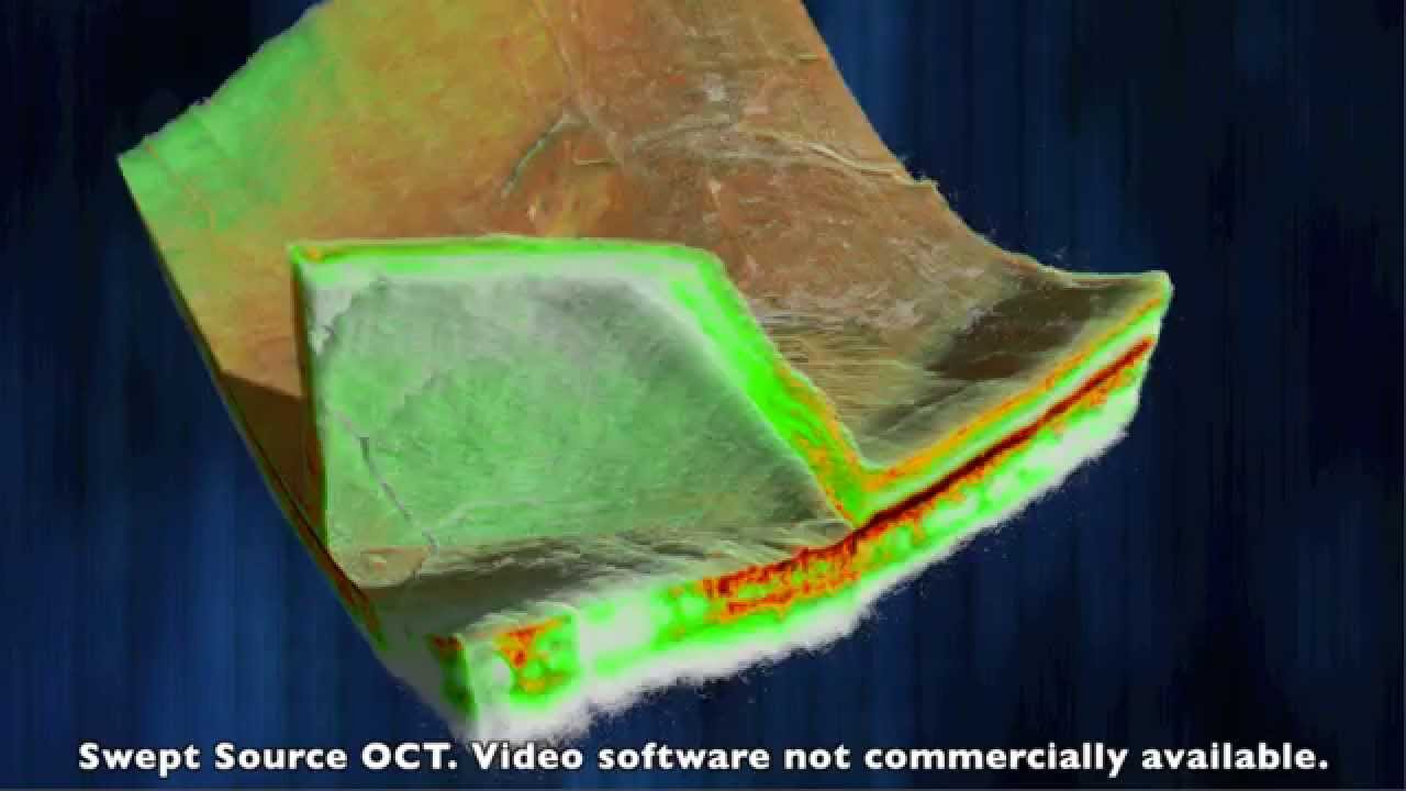 Swept Source OCT Posterior Chamber