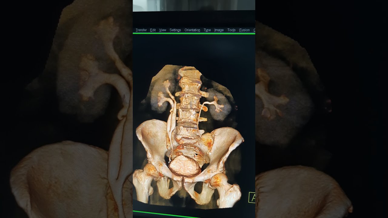 incomplete duplication of ureter (duplex kidney)