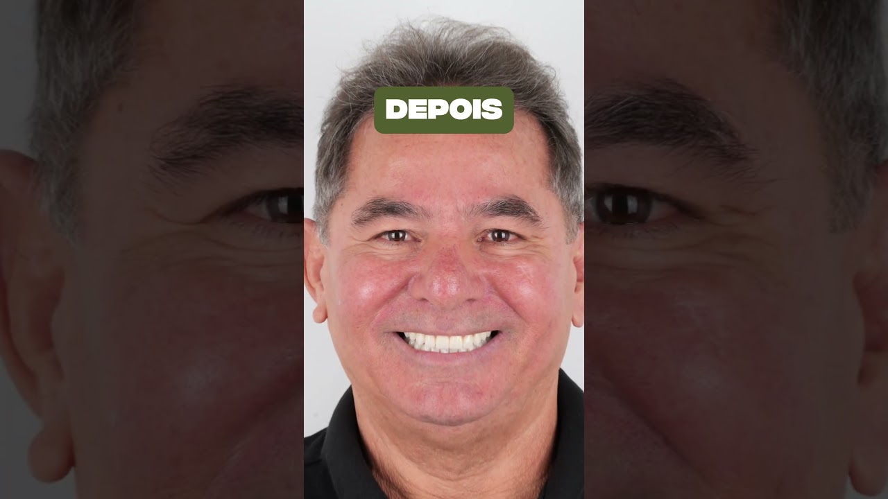Transforma&ccedil;&atilde;o Com Implantes Dent&aacute;rios - Implace Implantes